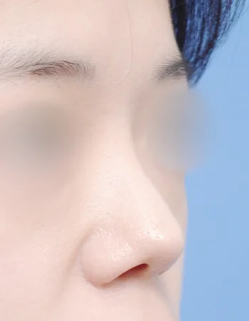  수술 전