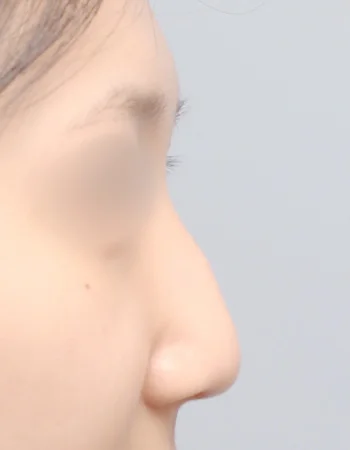  수술 전