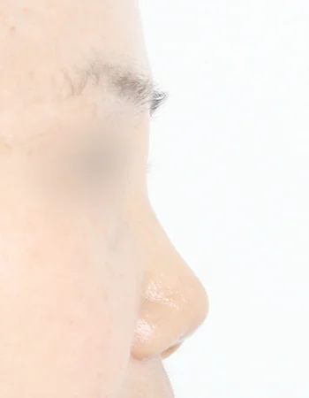  수술 전