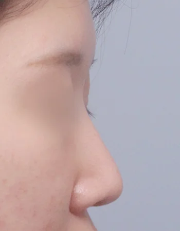  수술 전