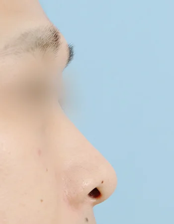  수술 전