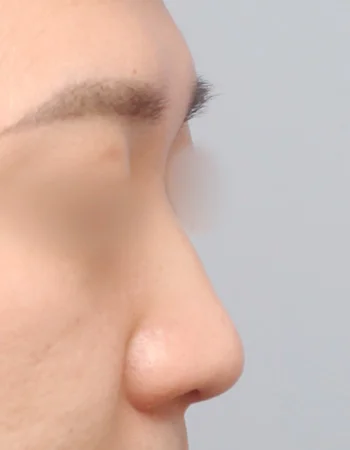  수술 전