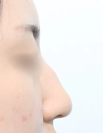  수술 전