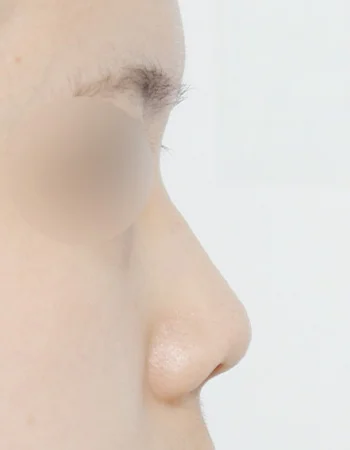  수술 전