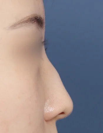  수술 전