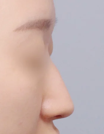  수술 전