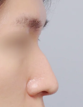  수술 전