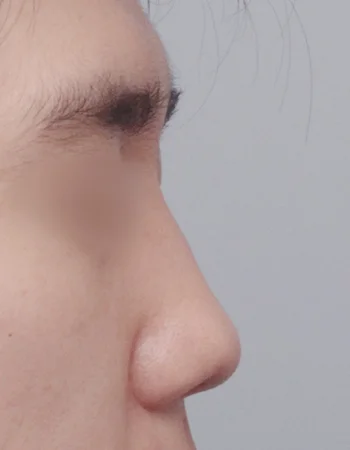  수술 전