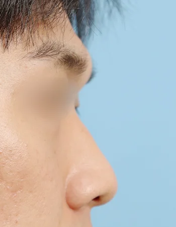  수술 전