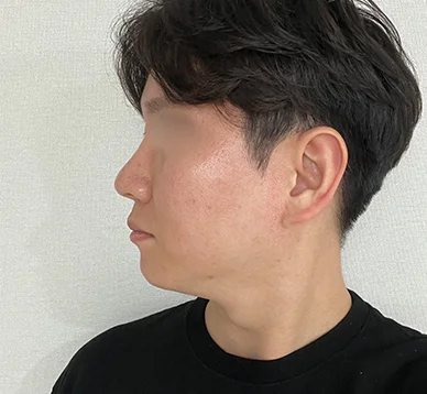 비염, 코막힘 스트레스 드디어 해결했습니다!!_남자기능코후기