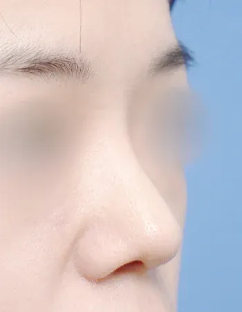  수술 후