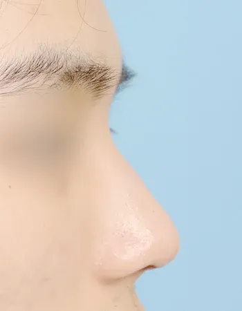  수술 후