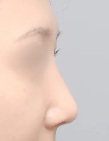  수술 후