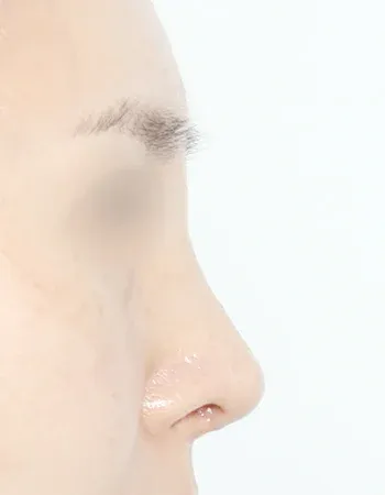  수술 후