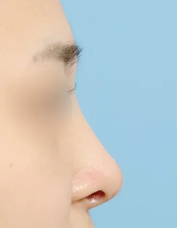  수술 후