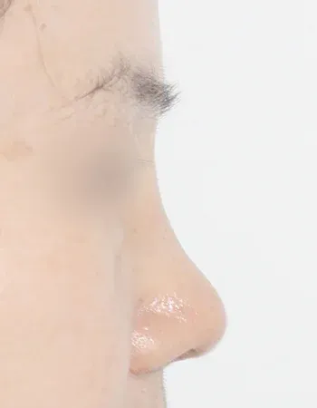  수술 후