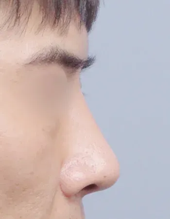  수술 후