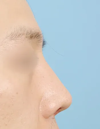  수술 후