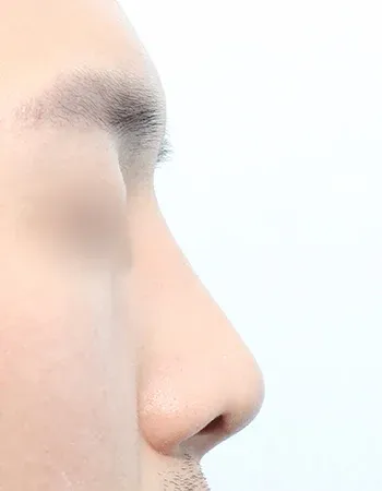  수술 후