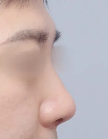  수술 후