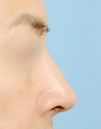  수술 후