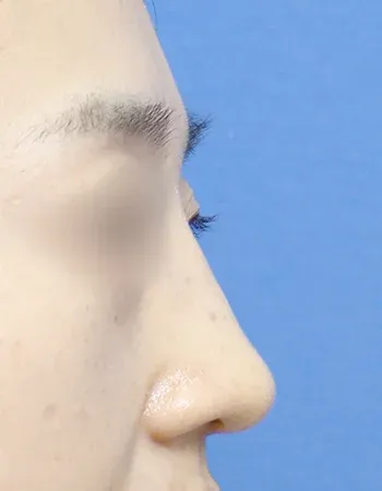  수술 후
