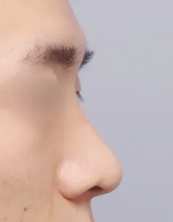  수술 후