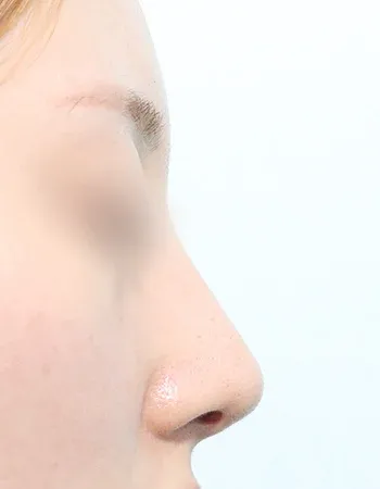  수술 후