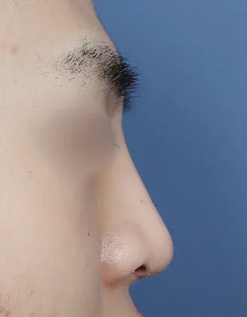  수술 후
