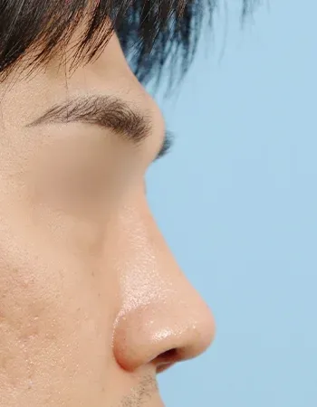  수술 후