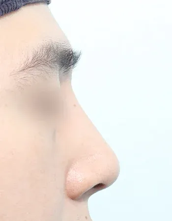  수술 후