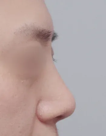  수술 후