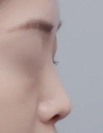  수술 후
