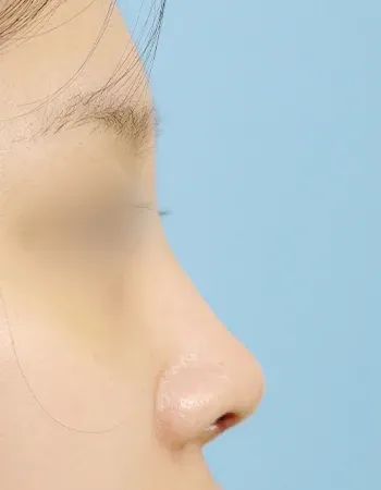  수술 후