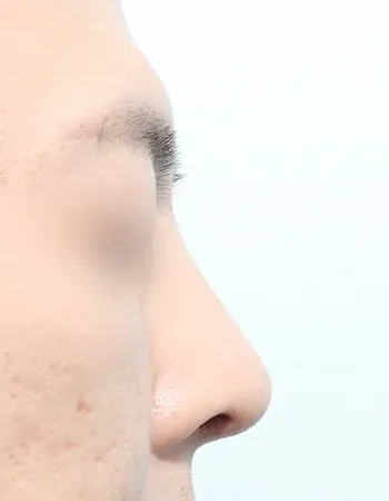  수술 후