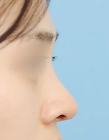  수술 후