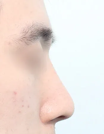  수술 후