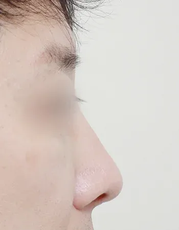  수술 후