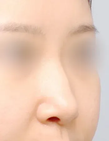  수술 전