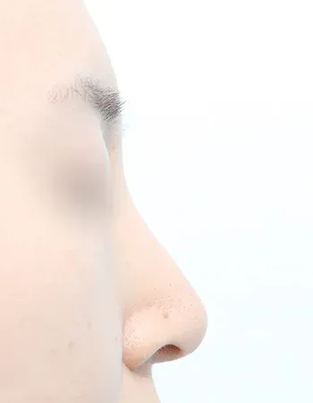  수술 전