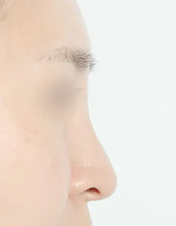  수술 전