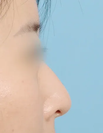  수술 전
