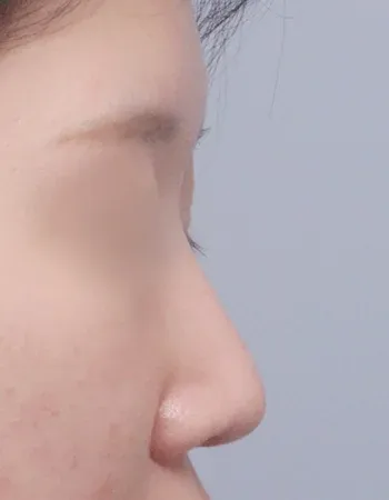  수술 전