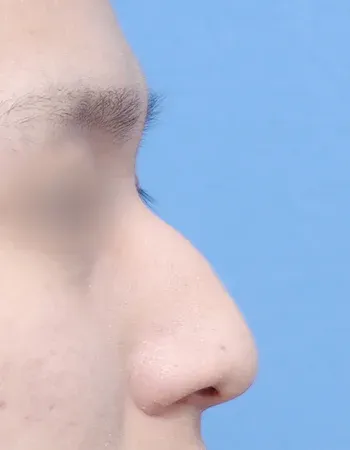  수술 전