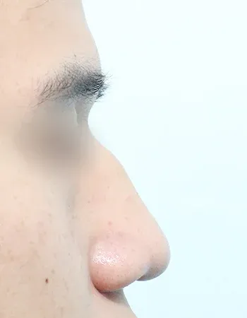  수술 전