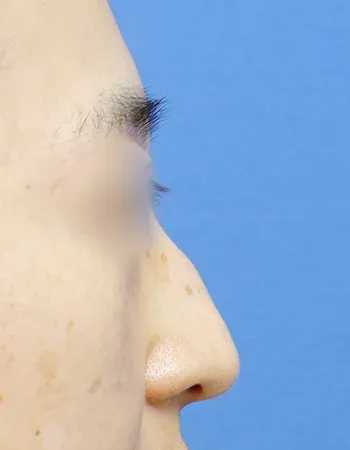  수술 전