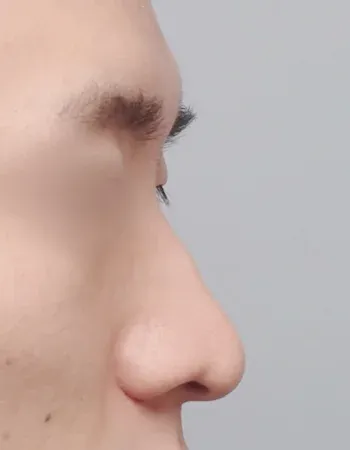  수술 전