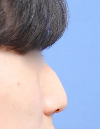  수술 전