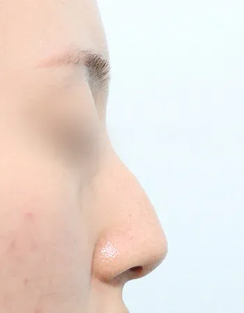  수술 전