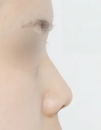  수술 전